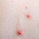 3 أسئلة وإجاباتها عن الجدري المائي