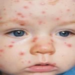 أهم 6 طرق لعلاج جدري الماء عند الأطفال