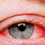 11 سبب للإصابة باحمرار العين