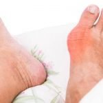 تعرف على 6 مضاعفات تحدث لمرضى النقرس و كيفية علاجه