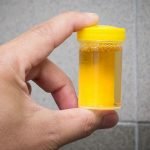 4 أسباب لإجراء تحليل البول
