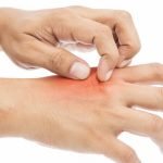 إليك 4 خطوات لعلاج الطفح الجلدي