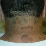 7 طرق لعلاج التينيا الملونة