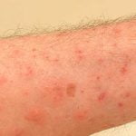 أهم 5 طرق وقائية تحمي بها نفسك من الجرب