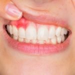 هل تعاني من انتفاخ اللثة؟ تعرف على أهم 3 طرق لعلاجها