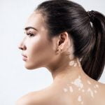 10 حقائق عن مرض البهاق