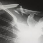 سؤال طبي حول معنى وجود spondylodegenerative في الأشعة