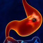 أعراض قرحة المعدة وعلاجها