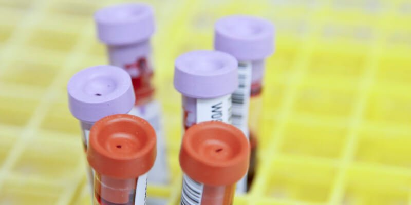6 معلومات طبية حول تحليل INR .. أحد أهم تحليل الدم