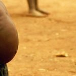 بحث عن مرض الكواشيوركور.. 5 وسائل لعلاج