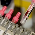 3 معلومات طبية حول تحليل الدم ASLO