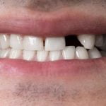 ما هو تفسير رؤية سقوط الأسنان في المنام .. 5 تفسيرات وتأويلات بين الخير والشر